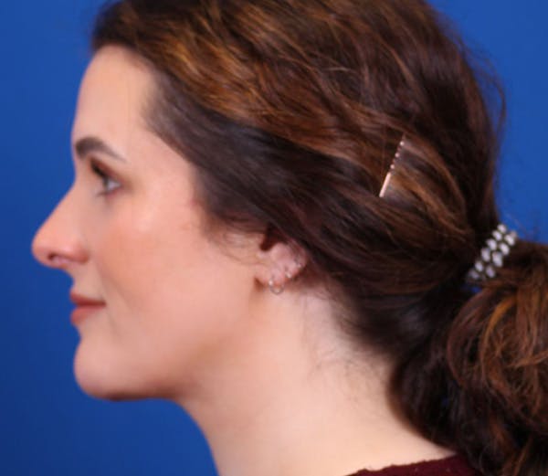Neck Contouring Before & After Gallery - Patient 143650849 - Image 4