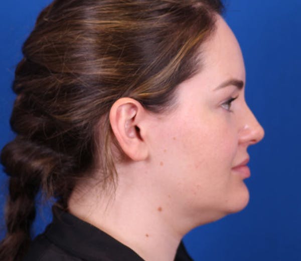 Neck DeFINE Before & After Gallery - Patient 143650851 - Image 3