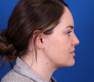 Neck DeFINE Before & After Gallery - Patient 143650851 - Image 4