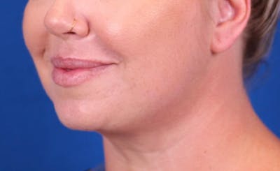 Neck deFINE Before & After Gallery - Patient 144176075 - Image 2