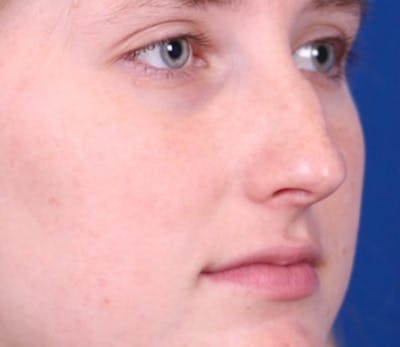 Rhinoplasty Before & After Gallery - Patient 144176078 - Image 1