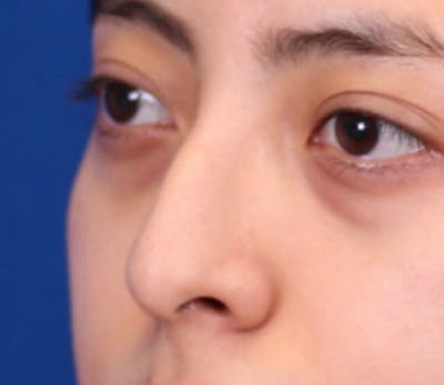 Rhinoplasty Before & After Gallery - Patient 144176079 - Image 1