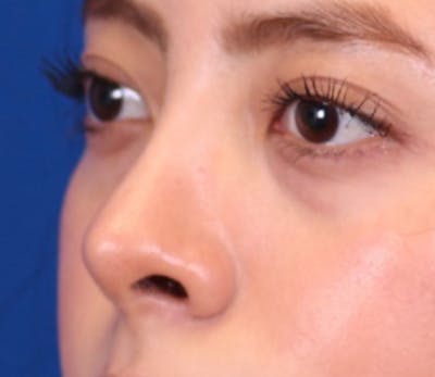 Rhinoplasty Before & After Gallery - Patient 144176079 - Image 2