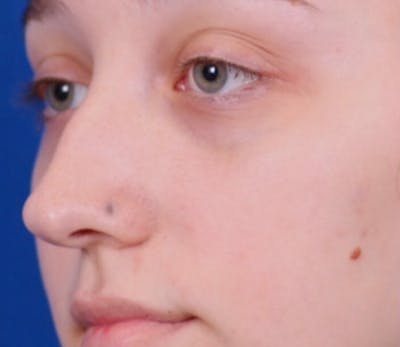 Rhinoplasty Before & After Gallery - Patient 144176080 - Image 1