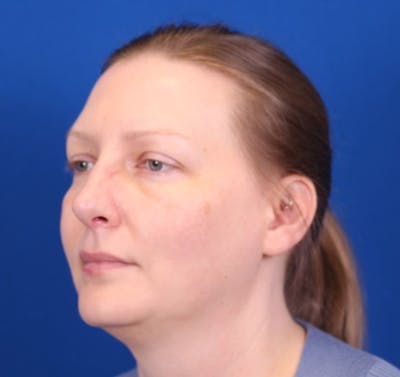 Rhinoplasty Before & After Gallery - Patient 146210125 - Image 2