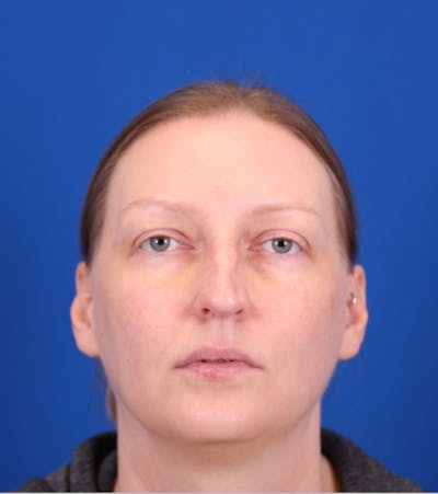 Rhinoplasty Before & After Gallery - Patient 146210125 - Image 1