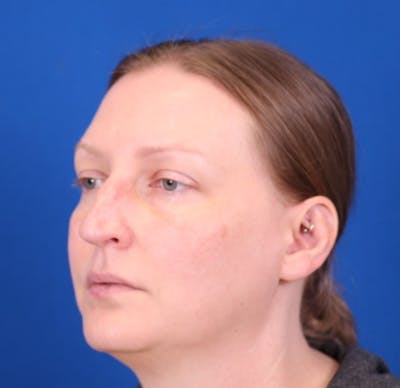 Rhinoplasty Before & After Gallery - Patient 146210125 - Image 1