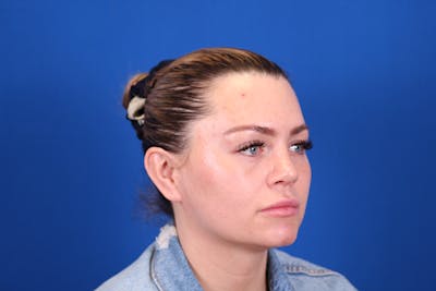 Rhinoplasty Before & After Gallery - Patient 146210126 - Image 4