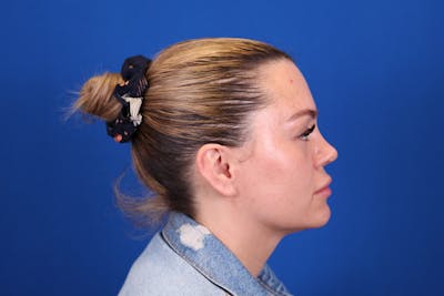 Rhinoplasty Before & After Gallery - Patient 146210126 - Image 6