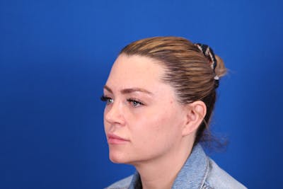 Rhinoplasty Before & After Gallery - Patient 146210126 - Image 8
