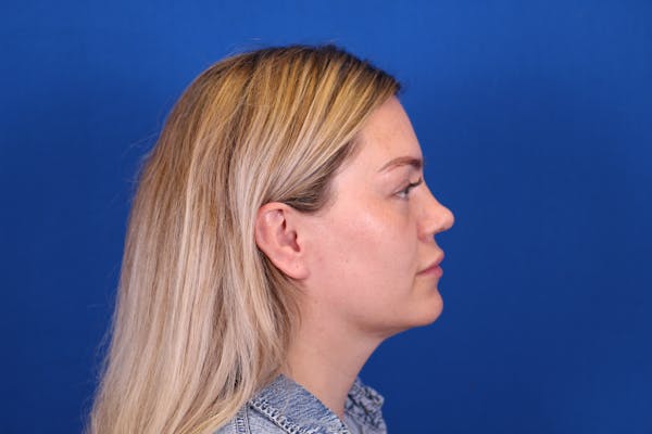 Rhinoplasty Before & After Gallery - Patient 146210126 - Image 1