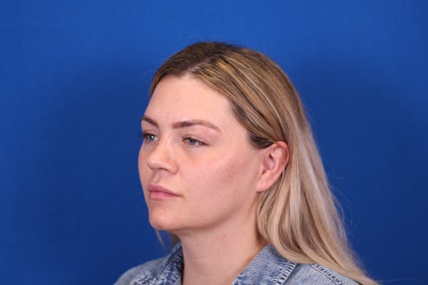 Rhinoplasty Before & After Gallery - Patient 146210126 - Image 7