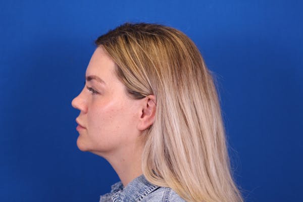 Rhinoplasty Before & After Gallery - Patient 146210126 - Image 9