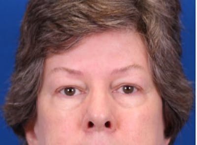 Blepharoplasty Before & After Gallery - Patient 148021786 - Image 1