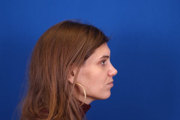 Rhinoplasty Before & After Gallery - Patient 146210128 - Image 2