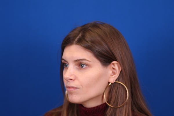Rhinoplasty Before & After Gallery - Patient 146210128 - Image 6