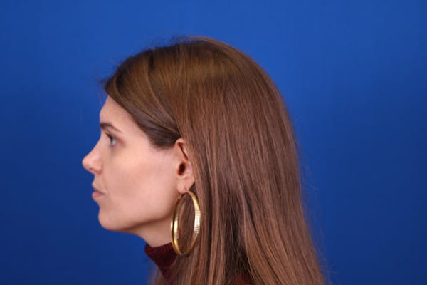 Rhinoplasty Before & After Gallery - Patient 146210128 - Image 8