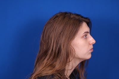 Rhinoplasty Before & After Gallery - Patient 146210128 - Image 1