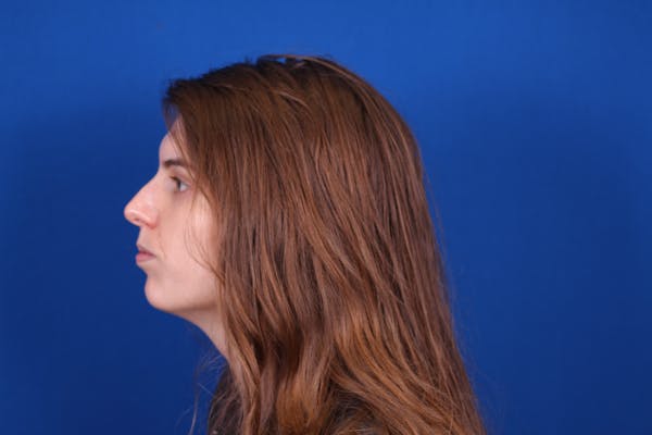 Rhinoplasty Before & After Gallery - Patient 146210128 - Image 7