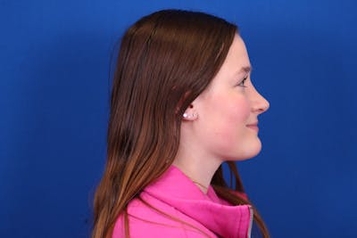 Rhinoplasty Before & After Gallery - Patient 146210129 - Image 10