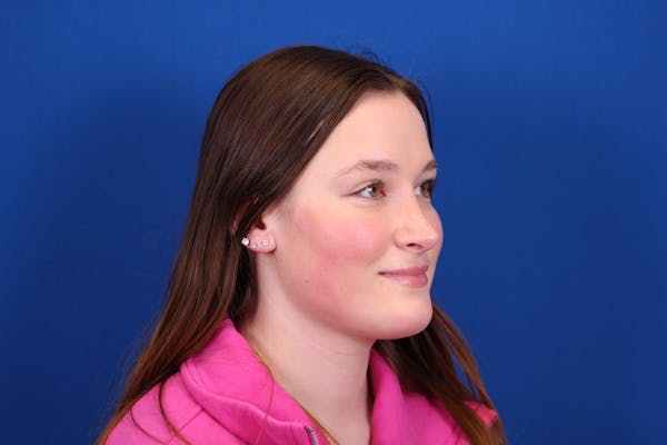 Rhinoplasty Before & After Gallery - Patient 146210129 - Image 6