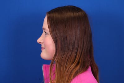 Rhinoplasty Before & After Gallery - Patient 146210129 - Image 2