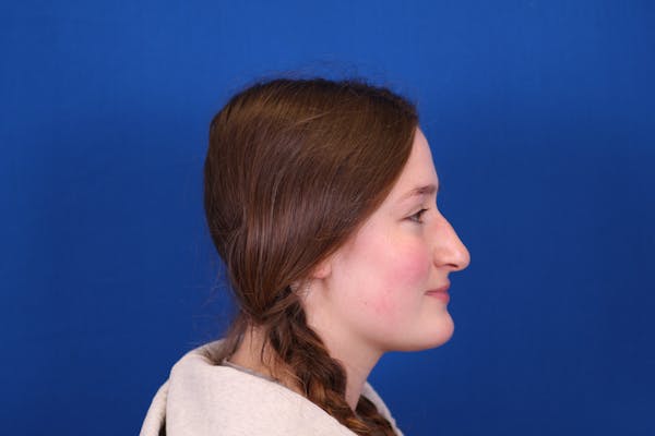 Rhinoplasty Before & After Gallery - Patient 146210129 - Image 9