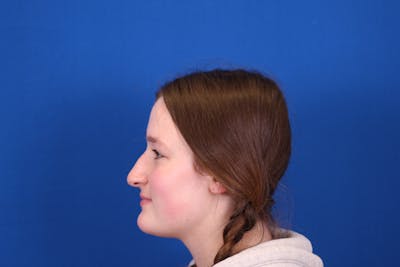 Rhinoplasty Before & After Gallery - Patient 146210129 - Image 1