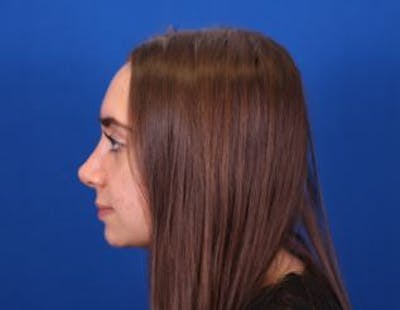 Rhinoplasty Before & After Gallery - Patient 146210130 - Image 2