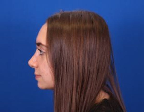 Rhinoplasty Before & After Gallery - Patient 146210130 - Image 2