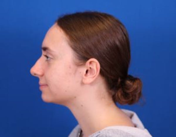 Rhinoplasty Before & After Gallery - Patient 146210130 - Image 1