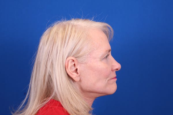 Facelift/Neck Lift Before & After Gallery - Patient 148021784 - Image 6