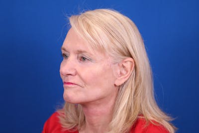 Facelift/Neck Lift Before & After Gallery - Patient 148021784 - Image 4