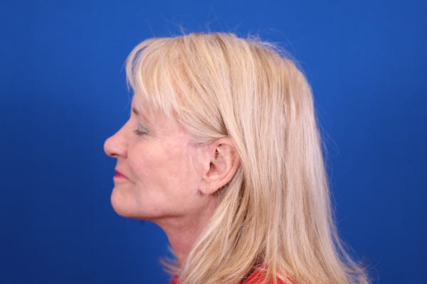 Rhinoplasty Before & After Gallery - Patient 146210131 - Image 2