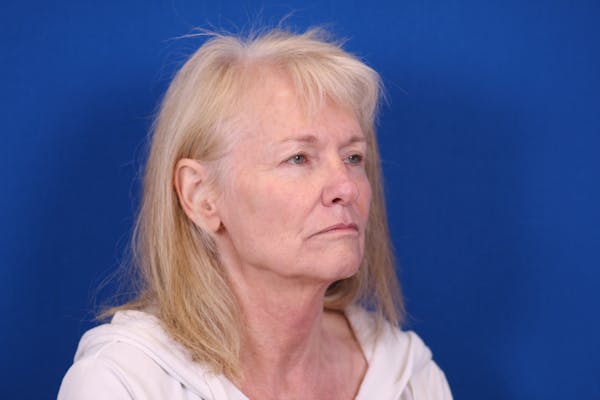 Facelift/Neck Lift Before & After Gallery - Patient 148021784 - Image 7