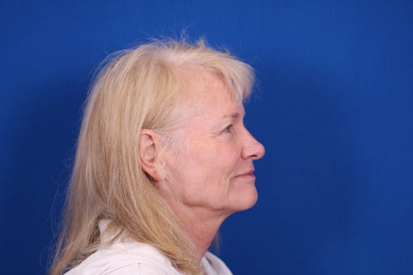 Facelift/Neck Lift Before & After Gallery - Patient 148021784 - Image 5