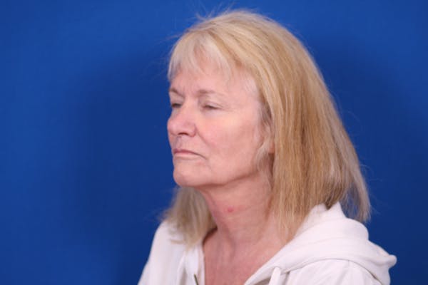 Facelift/Neck Lift Before & After Gallery - Patient 148021784 - Image 3