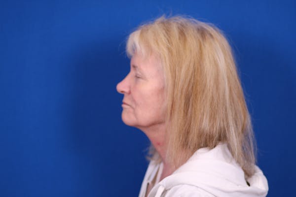 Facelift/Neck Lift Before & After Gallery - Patient 148021784 - Image 1