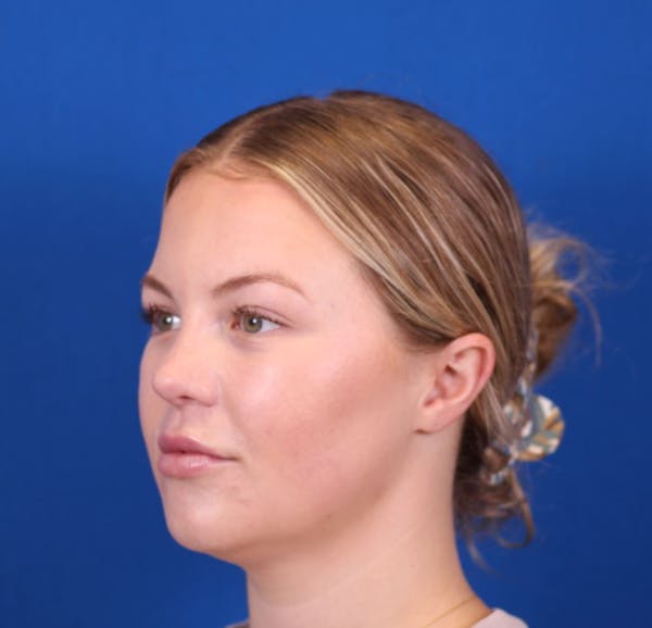 Rhinoplasty Before & After Gallery - Patient 146210132 - Image 4