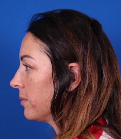 Rhinoplasty Before & After Gallery - Patient 147644269 - Image 1
