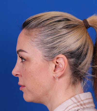 Rhinoplasty Before & After Gallery - Patient 147644269 - Image 2