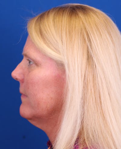 Facelift/Neck Lift Before & After Gallery - Patient 147703817 - Image 1