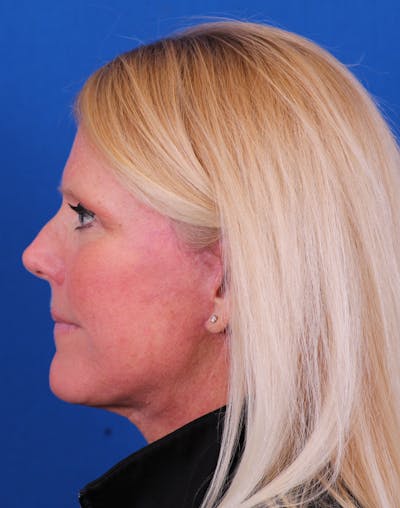 Facelift/Neck Lift Before & After Gallery - Patient 147703817 - Image 2