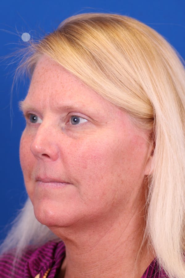 Facelift/Neck Lift Before & After Gallery - Patient 147703817 - Image 3