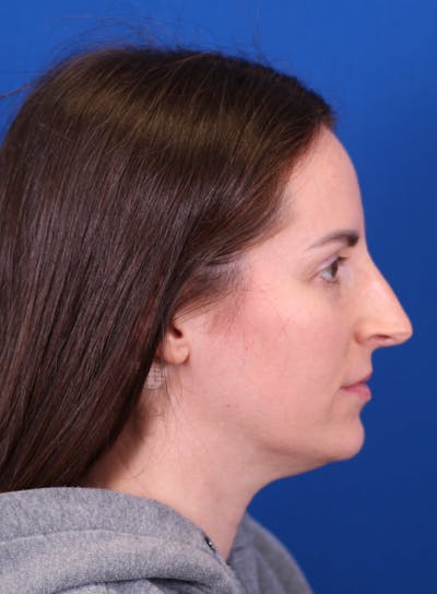 Rhinoplasty Before & After Gallery - Patient 148021125 - Image 1