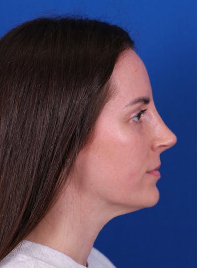 Rhinoplasty Before & After Gallery - Patient 148021125 - Image 2