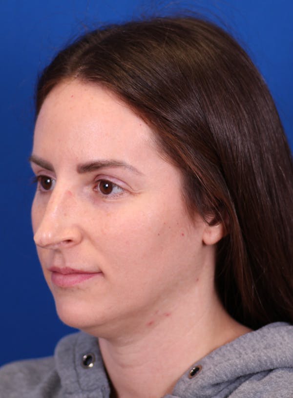 Rhinoplasty Before & After Gallery - Patient 148021125 - Image 3