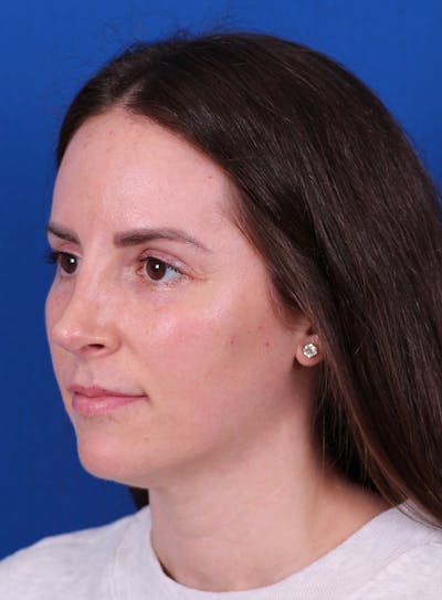 Rhinoplasty Before & After Gallery - Patient 148021125 - Image 4