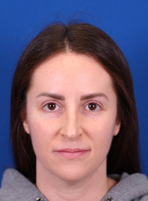 Rhinoplasty Before & After Gallery - Patient 148021125 - Image 5