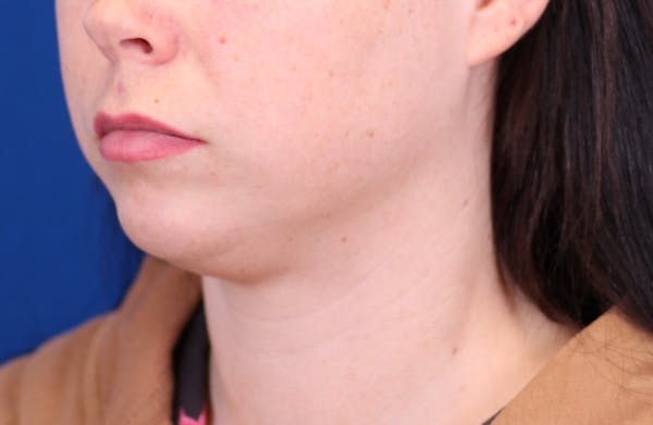 Neck deFINE Before & After Gallery - Patient 148021161 - Image 1